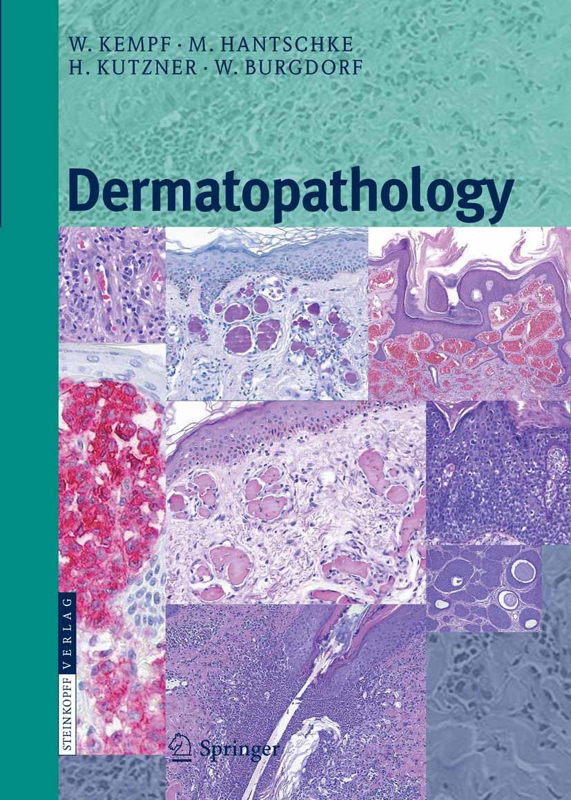 Titlebook: Dermatopathology; Werner Kempf,Markus Hantschke,Walter H. C. Burgdor Book 2008 Steinkopff-Verlag Darmstadt 2008 Dermatology.Dermatopatholo Titlebook: Dermatopathology; Werner Kempf,Markus Hantschke,Walter H. C. Burgdor Book 2008 Steinkopff-Verlag Darmstadt 2008 Dermatology.Dermatopatholo