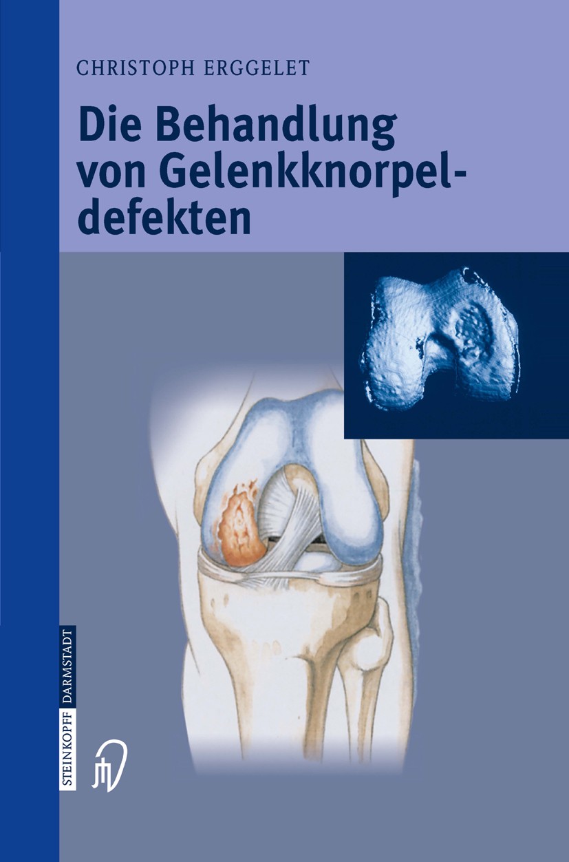 Titlebook: Die Behandlung von Gelenkknorpeldefekten; Christoph Erggelet Book 2004 Springer-Verlag Berlin Heidelberg 2004 Chondrozytentransplantation. Titlebook: Die Behandlung von Gelenkknorpeldefekten; Christoph Erggelet Book 2004 Springer-Verlag Berlin Heidelberg 2004 Chondrozytentransplantation.