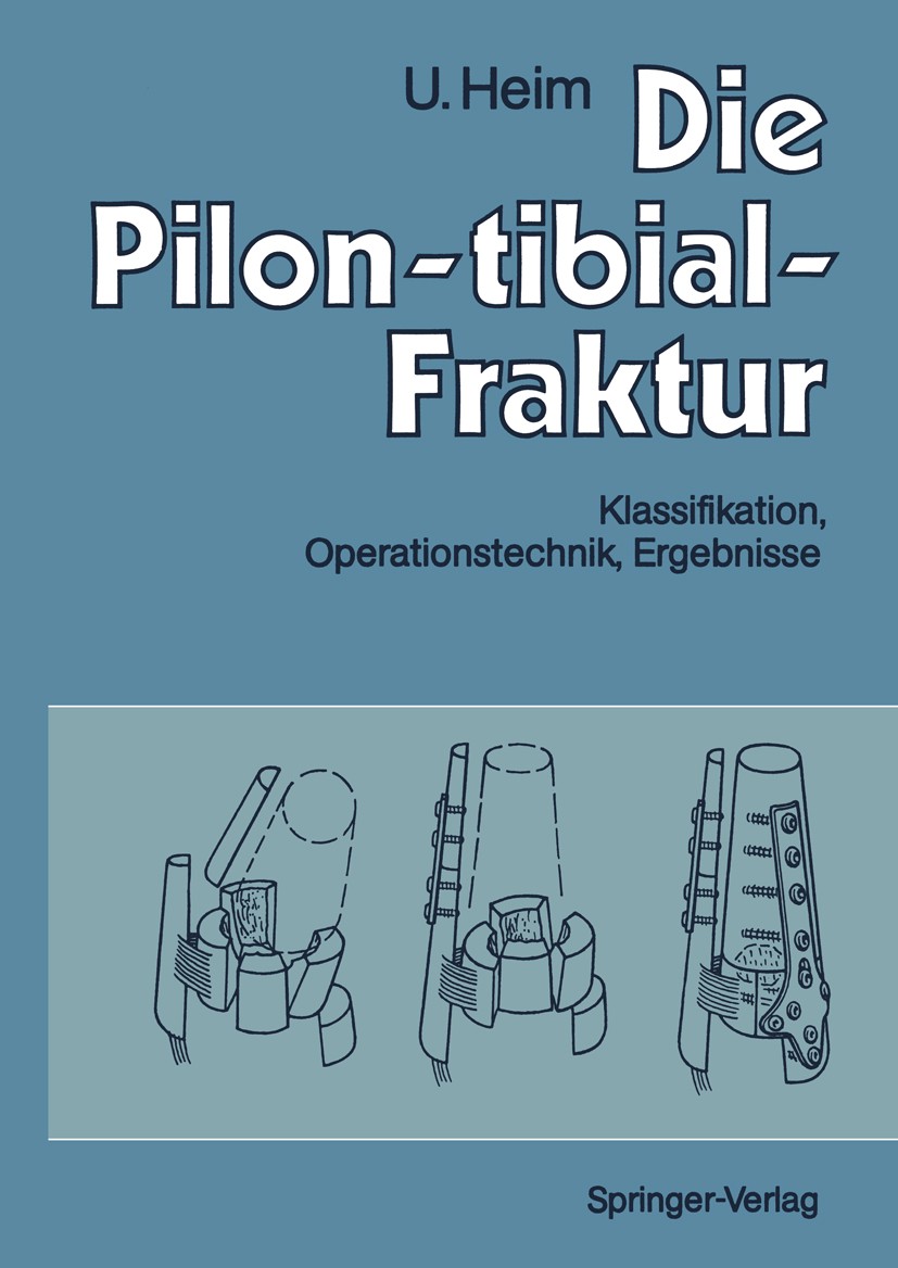 Titlebook: Die Pilon-tibial-Fraktur; Klassifikation, Oper Urs Heim Book 1991 Springer-Verlag Berlin Heidelberg 1991 Fraktur.Komplikation.Pilon-tibial- Titlebook: Die Pilon-tibial-Fraktur; Klassifikation, Oper Urs Heim Book 1991 Springer-Verlag Berlin Heidelberg 1991 Fraktur.Komplikation.Pilon-tibial-