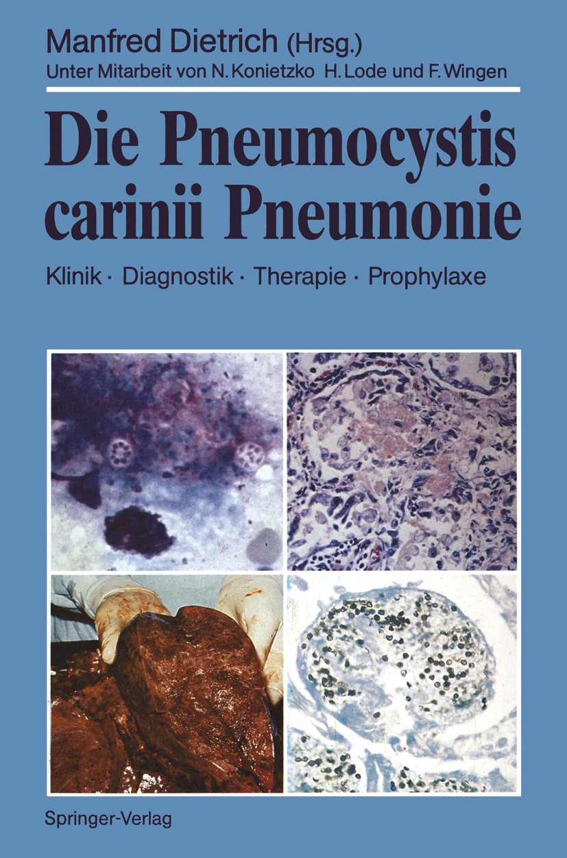 Titlebook: Die Pneumocystis carinii Pneumonie; Klinik · Diagnostik M. Dietrich Conference proceedings 1989 Springer-Verlag Berlin Heidelberg 1989 AID Titlebook: Die Pneumocystis carinii Pneumonie; Klinik · Diagnostik M. Dietrich Conference proceedings 1989 Springer-Verlag Berlin Heidelberg 1989 AID