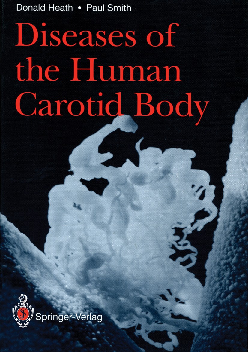 Titlebook: Diseases of the Human Carotid Body; Donald Heath,Paul Smith Book 1992 Springer-Verlag London Limited 1992 Chemodectoma.Chronic carotid glo Titlebook: Diseases of the Human Carotid Body; Donald Heath,Paul Smith Book 1992 Springer-Verlag London Limited 1992 Chemodectoma.Chronic carotid glo