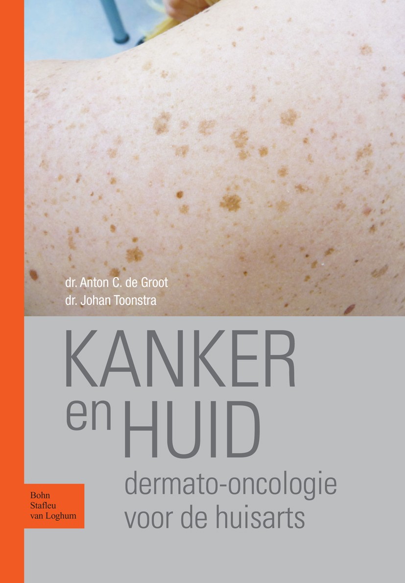 Titlebook: Kanker en huid; Dermato-oncologie vo A.C. Groot,J. Toonstra Book 2010Latest edition Bohn Stafleu van Loghum 2010 Titlebook: Kanker en huid; Dermato-oncologie vo A.C. Groot,J. Toonstra Book 2010Latest edition Bohn Stafleu van Loghum 2010