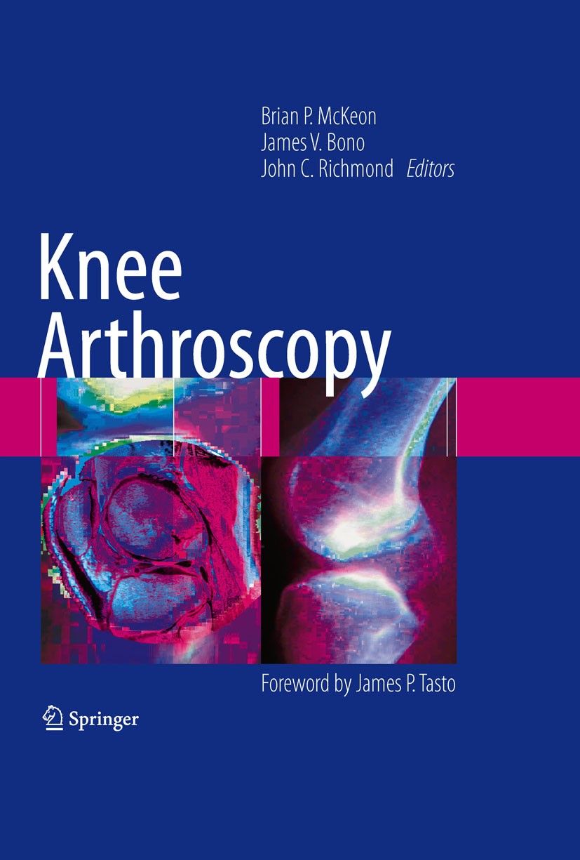 Titlebook: Knee Arthroscopy; John C. Richmond,James V. Bono,Brian P. McKeon Book 2009 Springer-Verlag New York 2009 Orthopaedics.anatomy.cartilage.co Titlebook: Knee Arthroscopy; John C. Richmond,James V. Bono,Brian P. McKeon Book 2009 Springer-Verlag New York 2009 Orthopaedics.anatomy.cartilage.co