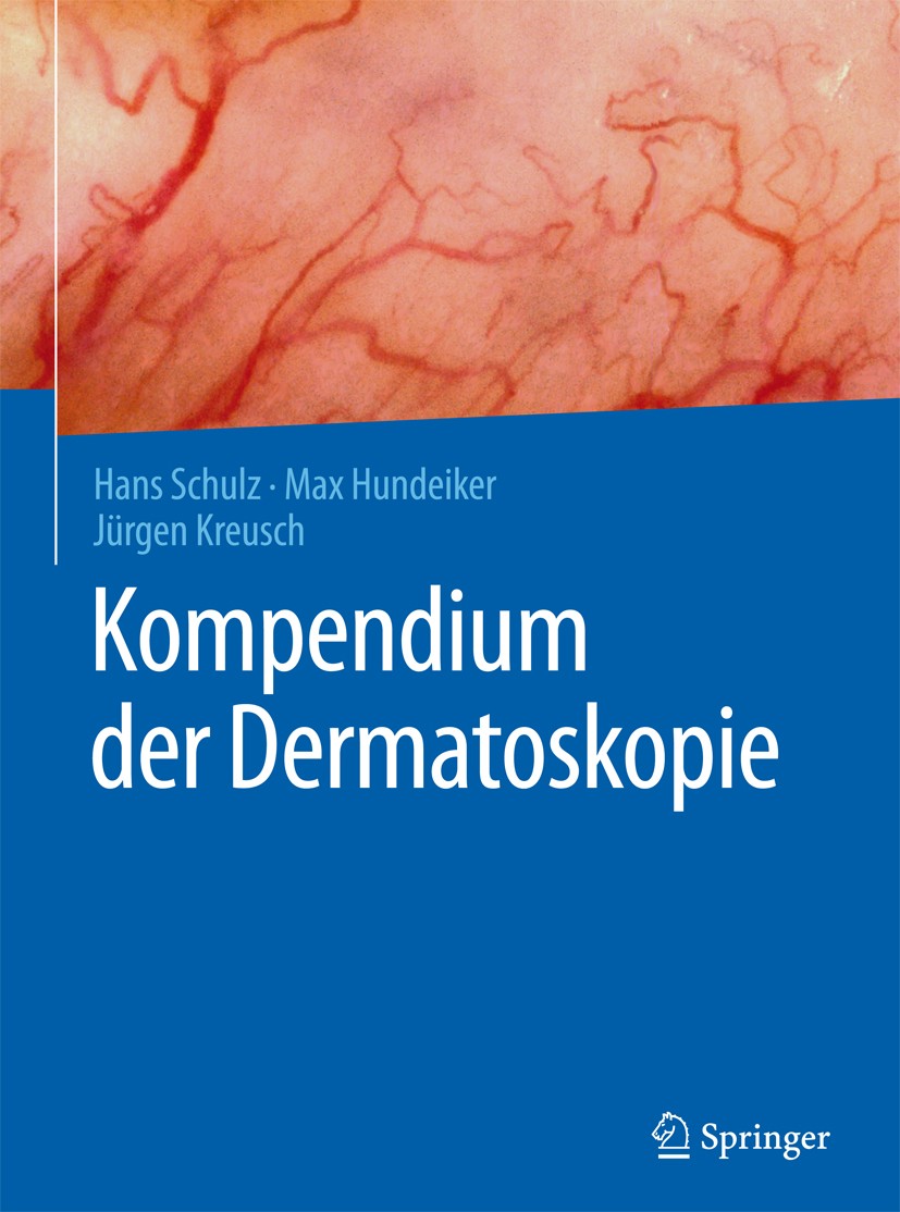 Titlebook: Kompendium der Dermatoskopie; Hans Schulz,Max Hundeiker,Jürgen Kreusch Book 2016 Springer-Verlag Berlin Heidelberg 2016 Auflichtmikroskopi Titlebook: Kompendium der Dermatoskopie; Hans Schulz,Max Hundeiker,Jürgen Kreusch Book 2016 Springer-Verlag Berlin Heidelberg 2016 Auflichtmikroskopi