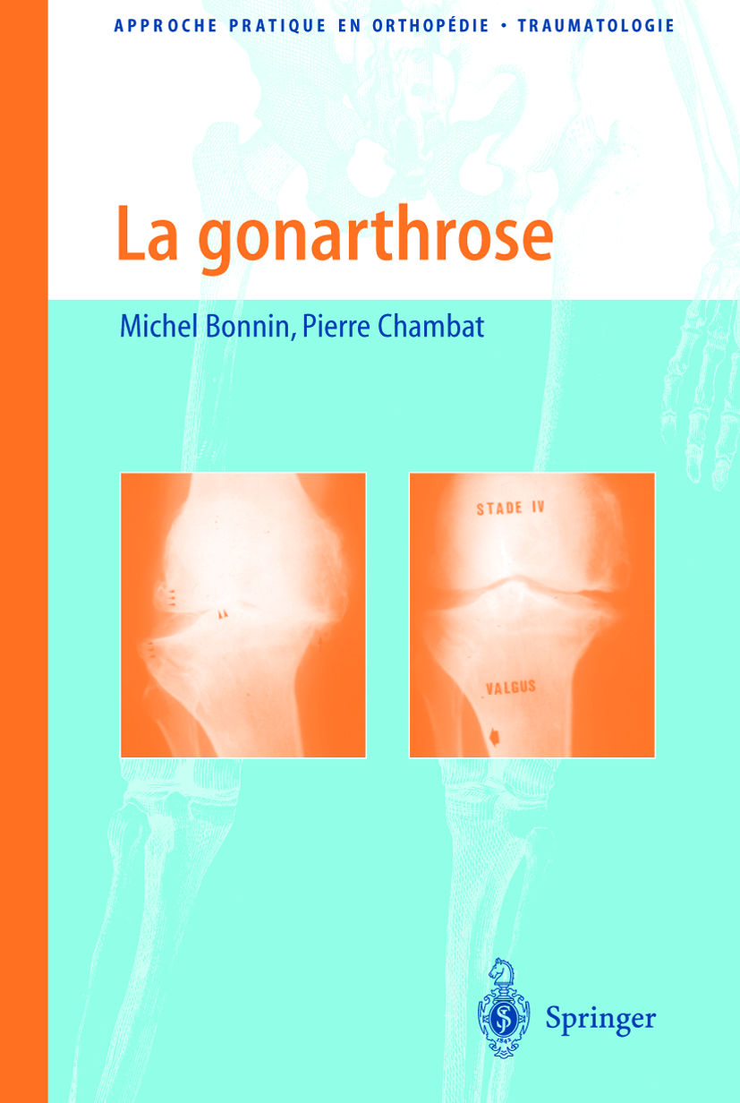 Titlebook: La gonarthrose; Traitement chirurgic Michel Bonnin,Pierre Chambat Book 2006Latest edition Springer-Verlag Paris 2006 arthrose du genou.oste Titlebook: La gonarthrose; Traitement chirurgic Michel Bonnin,Pierre Chambat Book 2006Latest edition Springer-Verlag Paris 2006 arthrose du genou.oste