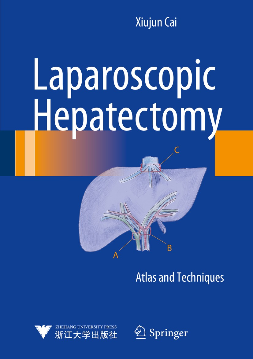 Titlebook: Laparoscopic Hepatectomy; Atlas and Techniques Xiujun Cai Book 2015 Springer Science+Business Media Dordrecht and Zhejiang University Press Titlebook: Laparoscopic Hepatectomy; Atlas and Techniques Xiujun Cai Book 2015 Springer Science+Business Media Dordrecht and Zhejiang University Press