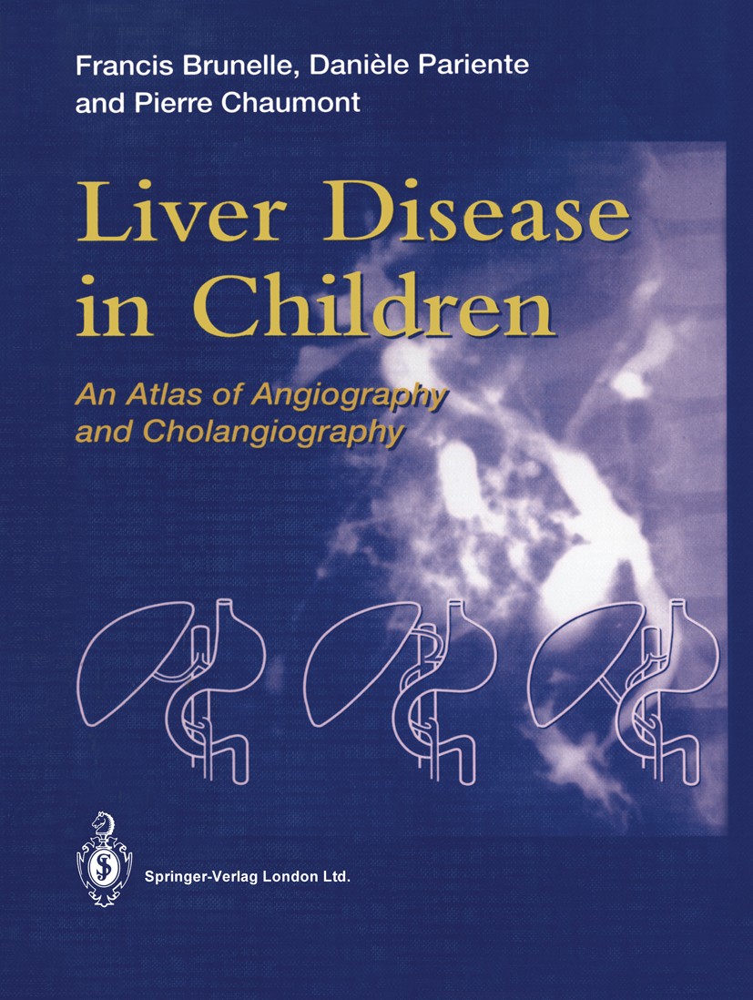 Titlebook: Liver Disease in Children; An Atlas of Angiogra Francis Brunelle,Danièle Pariente,Pierre Chaumont Book 1994 Springer-Verlag London 1994 Tum Titlebook: Liver Disease in Children; An Atlas of Angiogra Francis Brunelle,Danièle Pariente,Pierre Chaumont Book 1994 Springer-Verlag London 1994 Tum