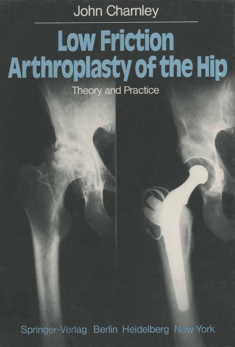 Titlebook: Low Friction Arthroplasty of the Hip; Theory and Practice John Charnley Book 1979 Springer-Verlag Berlin Heidelberg 1979 Hüftgelenk.Hüftgel Titlebook: Low Friction Arthroplasty of the Hip; Theory and Practice John Charnley Book 1979 Springer-Verlag Berlin Heidelberg 1979 Hüftgelenk.Hüftgel