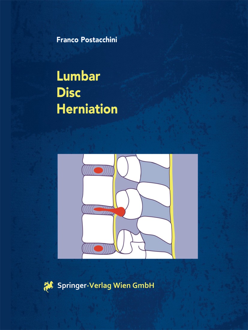 Titlebook: Lumbar Disc Herniation; Franco Postacchini Book 1999 Springer-Verlag Wien 1999 biochemistry.biomechanics.disc prolapse.discectomy.lumbar s Titlebook: Lumbar Disc Herniation; Franco Postacchini Book 1999 Springer-Verlag Wien 1999 biochemistry.biomechanics.disc prolapse.discectomy.lumbar s