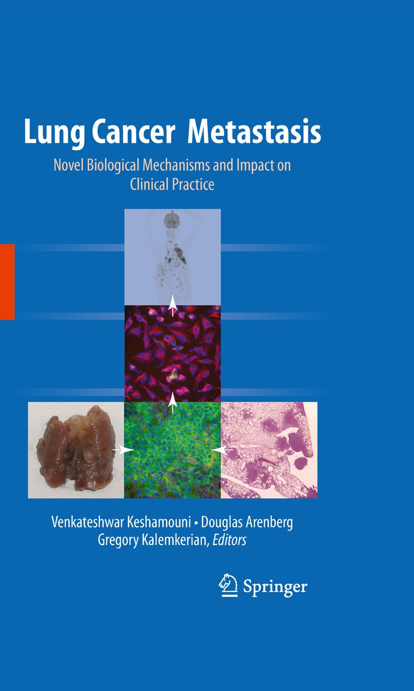 Titlebook: Lung Cancer Metastasis; Novel Biological Mec Venkateshwar Keshamouni,Douglas Arenberg,Gregory K Book 2010 Springer-Verlag New York 2010 ang Titlebook: Lung Cancer Metastasis; Novel Biological Mec Venkateshwar Keshamouni,Douglas Arenberg,Gregory K Book 2010 Springer-Verlag New York 2010 ang