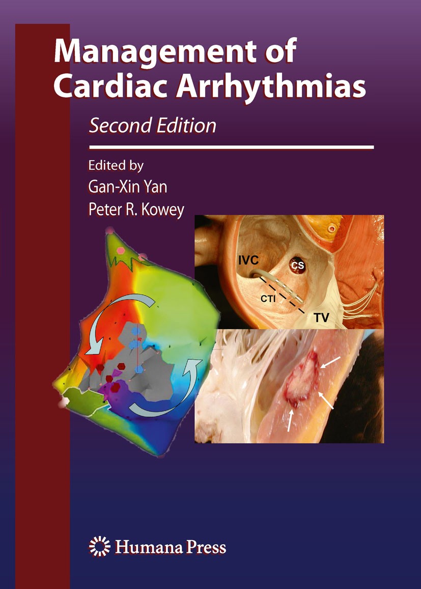 Titlebook: Management of Cardiac Arrhythmias; Gan-Xin Yan,Peter R. Kowey Book 20112nd edition Springer Science+Business Media, LLC 2011 Arrhythmogene Titlebook: Management of Cardiac Arrhythmias; Gan-Xin Yan,Peter R. Kowey Book 20112nd edition Springer Science+Business Media, LLC 2011 Arrhythmogene