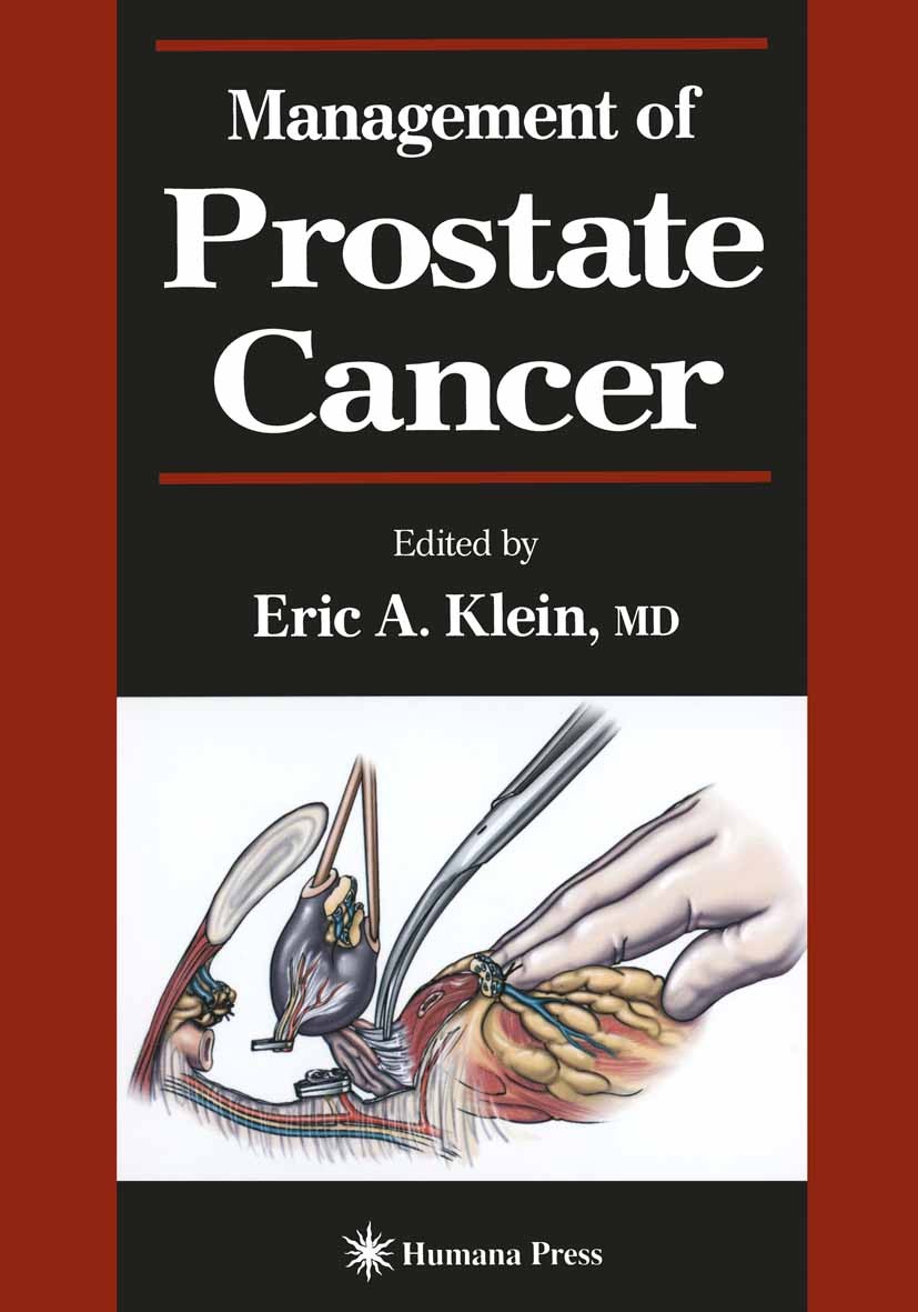 Titlebook: Management of Prostate Cancer; Eric A. Klein Book 2000 Springer Science+Business Media New York 2000 biopsy.cancer.metastasis.pathology.pr Titlebook: Management of Prostate Cancer; Eric A. Klein Book 2000 Springer Science+Business Media New York 2000 biopsy.cancer.metastasis.pathology.pr