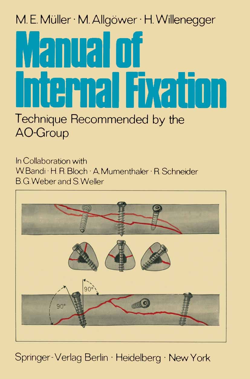 Titlebook: Manual of Internal Fixation; Technique Recommende M. E. Müller,M. Allgöwer,H. Willenegger Book 19701st edition Springer-Verlag Berlin · Hei Titlebook: Manual of Internal Fixation; Technique Recommende M. E. Müller,M. Allgöwer,H. Willenegger Book 19701st edition Springer-Verlag Berlin · Hei