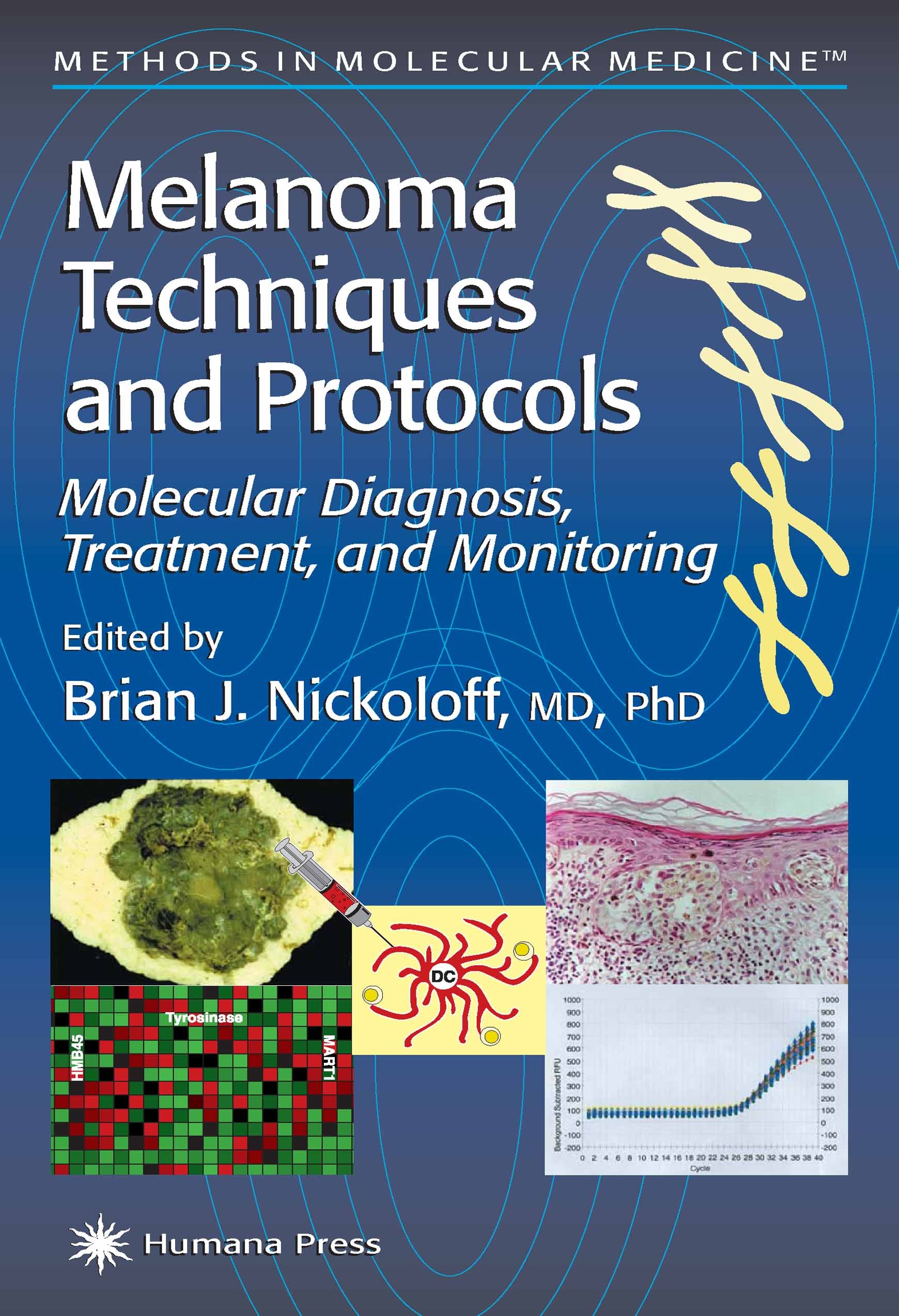 Titlebook: Melanoma Techniques and Protocols; Molecular Diagnosis, Brian J. Nickoloff,Leroy Hood (President and Direc Book 2001 Humana Press 2001 Titlebook: Melanoma Techniques and Protocols; Molecular Diagnosis, Brian J. Nickoloff,Leroy Hood (President and Direc Book 2001 Humana Press 2001