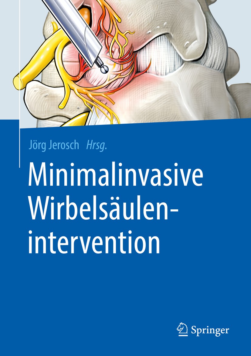 Titlebook: Minimalinvasive Wirbelsäulenintervention; Jörg Jerosch Book 2019 Springer-Verlag GmbH Deutschland, ein Teil von Springer Nature 2019 Neuro Titlebook: Minimalinvasive Wirbelsäulenintervention; Jörg Jerosch Book 2019 Springer-Verlag GmbH Deutschland, ein Teil von Springer Nature 2019 Neuro