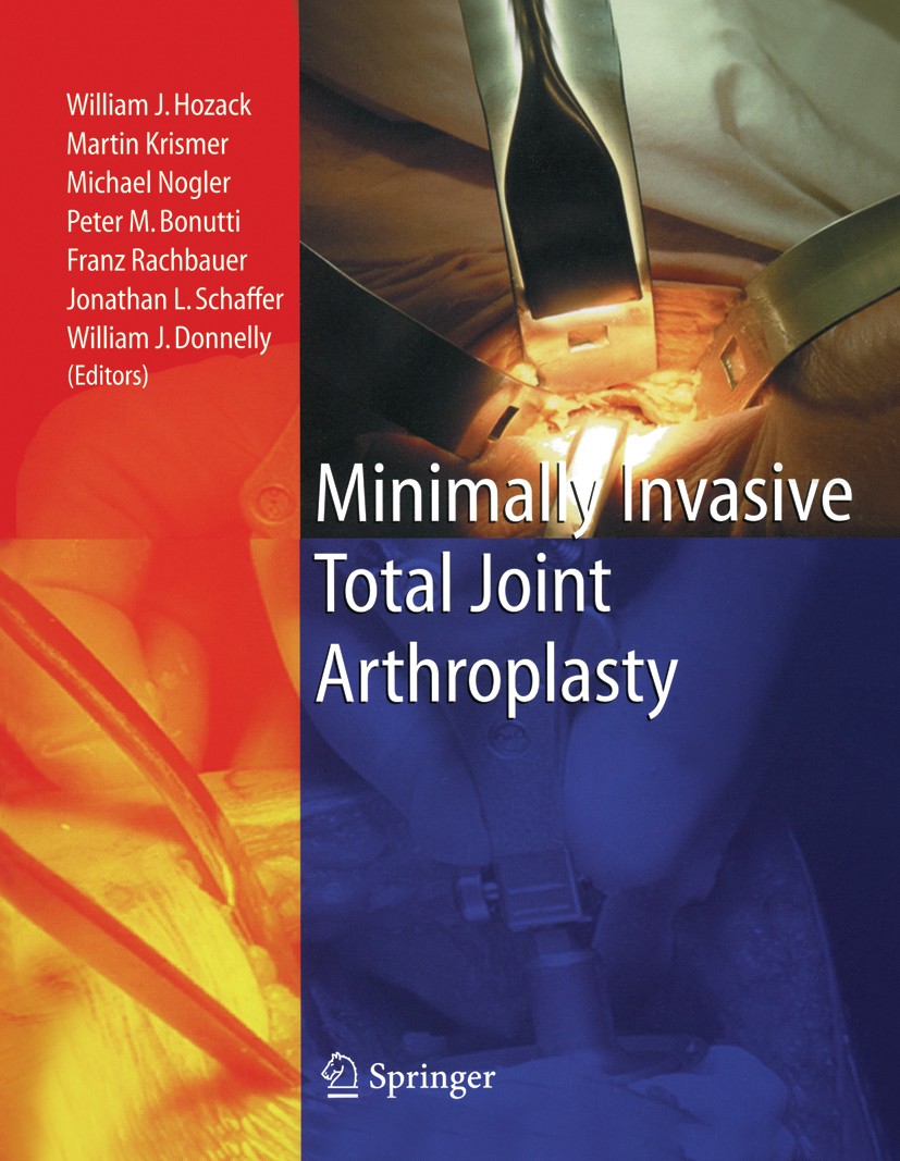 Titlebook: Minimally Invasive Total Joint Arthroplasty; William J. Hozack (Professor of Orthopedic Surgery Book 2004 Springer Medizin Verlag Heidelbe Titlebook: Minimally Invasive Total Joint Arthroplasty; William J. Hozack (Professor of Orthopedic Surgery Book 2004 Springer Medizin Verlag Heidelbe
