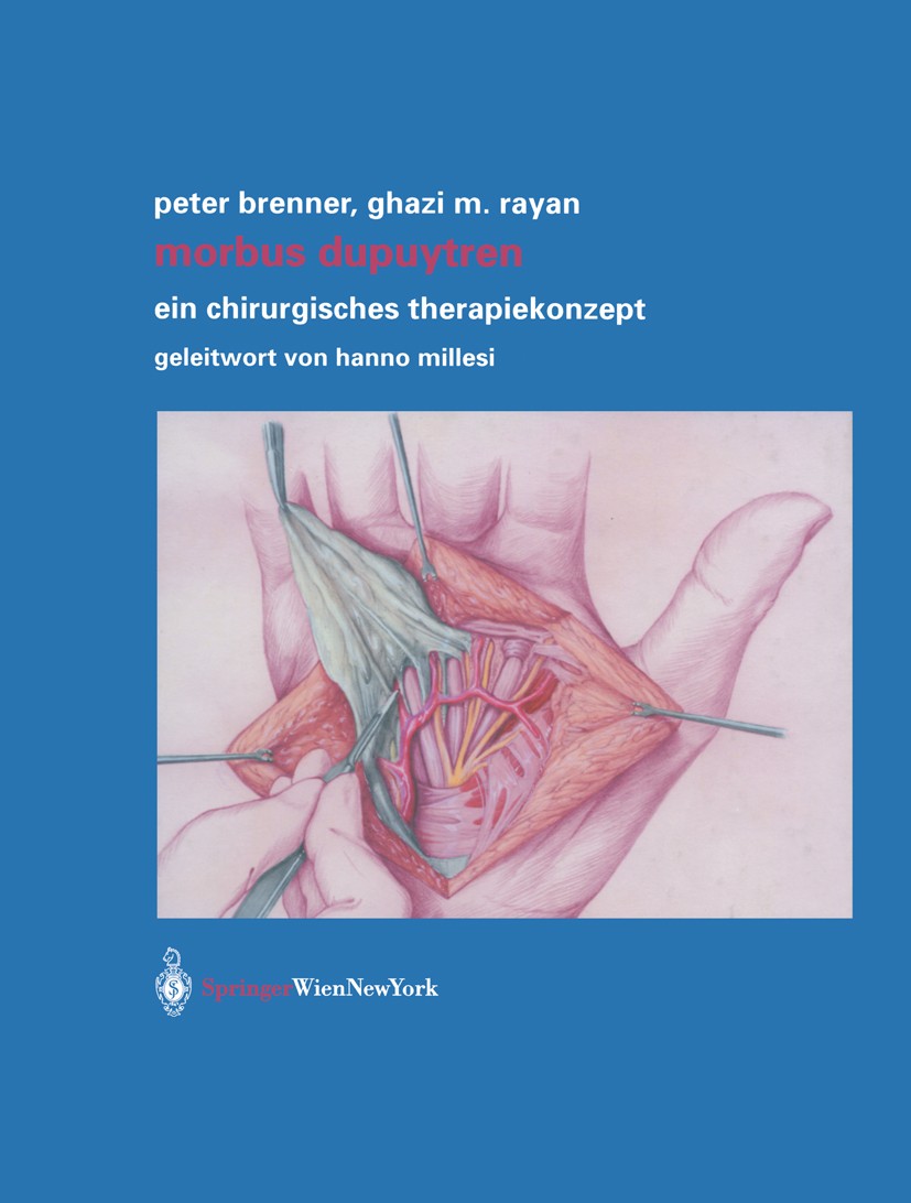 Titlebook: Morbus Dupuytren; Ein chirurgisches Th Peter Brenner,Ghazi M. Rayan Book 2003 Springer-Verlag/Wien 2003 Anatomie.Anatomie der Palmarfaszie. Titlebook: Morbus Dupuytren; Ein chirurgisches Th Peter Brenner,Ghazi M. Rayan Book 2003 Springer-Verlag/Wien 2003 Anatomie.Anatomie der Palmarfaszie.