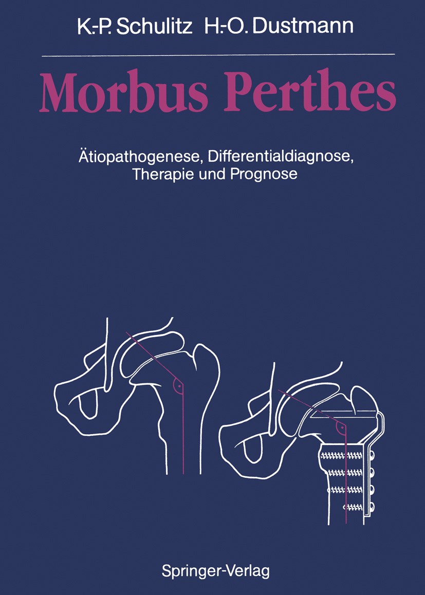 Titlebook: Morbus Perthes; Ätiopathogenese, Dif Klaus-Peter Schulitz,Hans-Otto Dustmann Book 19911st edition Springer-Verlag Berlin Heidelberg 1991 Mo Titlebook: Morbus Perthes; Ätiopathogenese, Dif Klaus-Peter Schulitz,Hans-Otto Dustmann Book 19911st edition Springer-Verlag Berlin Heidelberg 1991 Mo