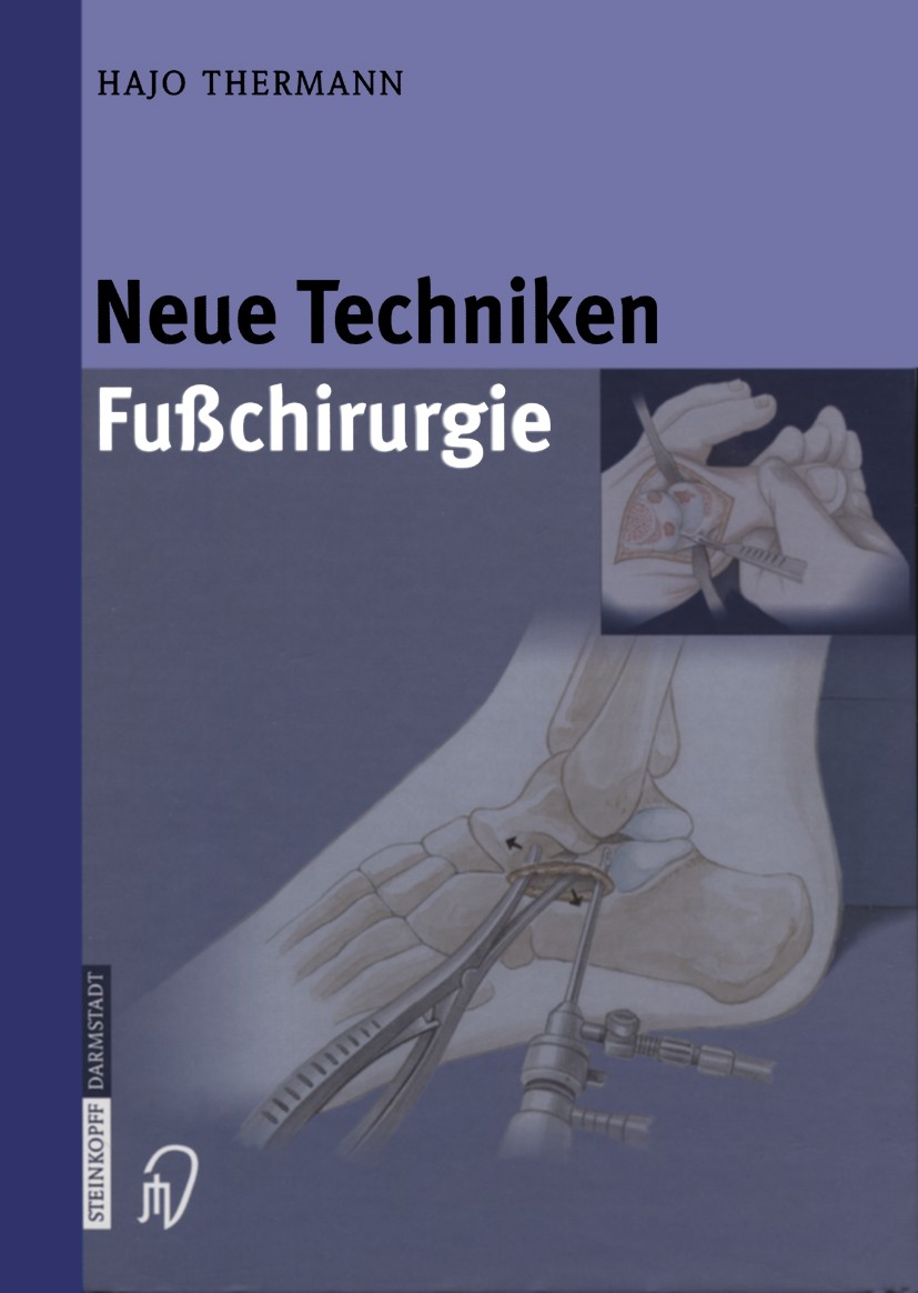 Titlebook: Neue Techniken Fusschirurgie; H. Thermann Book 20041st edition Springer-Verlag Berlin Heidelberg 2004 Achillessehne.Arthroskopie.Endoproth Titlebook: Neue Techniken Fusschirurgie; H. Thermann Book 20041st edition Springer-Verlag Berlin Heidelberg 2004 Achillessehne.Arthroskopie.Endoproth