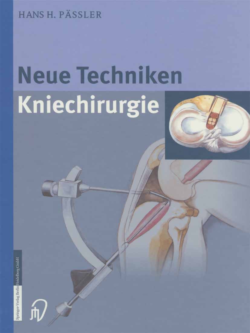 Titlebook: Neue Techniken Kniechirurgie; Hans H. Pässler Book 2002 Springer-Verlag Berlin Heidelberg 2002 Arthrose.Fraktur.Instabilität.Knie.Kniechir Titlebook: Neue Techniken Kniechirurgie; Hans H. Pässler Book 2002 Springer-Verlag Berlin Heidelberg 2002 Arthrose.Fraktur.Instabilität.Knie.Kniechir