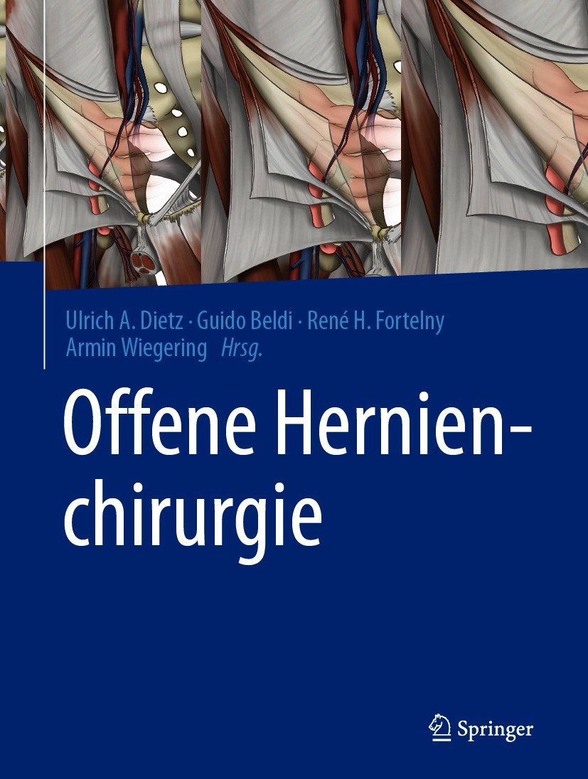 Titlebook: Offene Hernienchirurgie; Ulrich A. Dietz,Guido Beldi,Armin Wiegering Book 2021 Springer-Verlag GmbH Deutschland, ein Teil von Springer Nat Titlebook: Offene Hernienchirurgie; Ulrich A. Dietz,Guido Beldi,Armin Wiegering Book 2021 Springer-Verlag GmbH Deutschland, ein Teil von Springer Nat