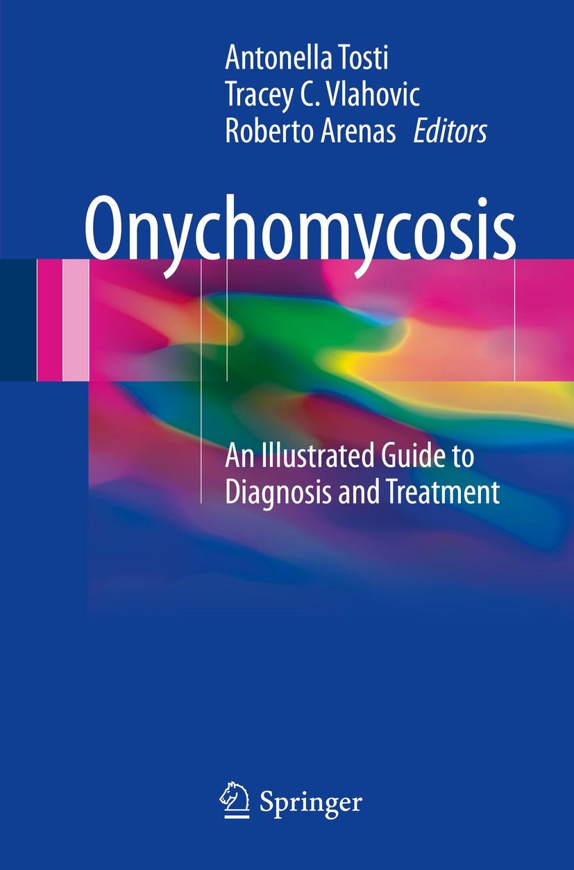 Titlebook: Onychomycosis; An Illustrated Guide Antonella Tosti,Tracey C. Vlahovic,Roberto Arenas Book 2017 Springer International Publishing Switzerla Titlebook: Onychomycosis; An Illustrated Guide Antonella Tosti,Tracey C. Vlahovic,Roberto Arenas Book 2017 Springer International Publishing Switzerla