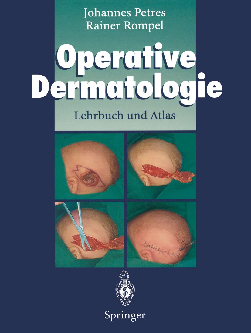 Titlebook: Operative Dermatologie; Lehrbuch und Atlas Johannes Petres,Rainer Rompel Book 19961st edition Springer-Verlag Berlin Heidelberg 1996 Basali Titlebook: Operative Dermatologie; Lehrbuch und Atlas Johannes Petres,Rainer Rompel Book 19961st edition Springer-Verlag Berlin Heidelberg 1996 Basali