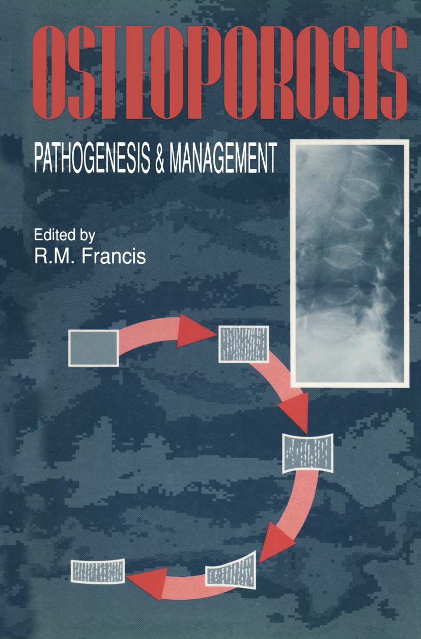 Titlebook: Osteoporosis; Pathogenesis and Man R. M. Francis (Honorary Consultant Physician Senio Book 1990 Springer Science+Business Media Dordrecht 1 Titlebook: Osteoporosis; Pathogenesis and Man R. M. Francis (Honorary Consultant Physician Senio Book 1990 Springer Science+Business Media Dordrecht 1