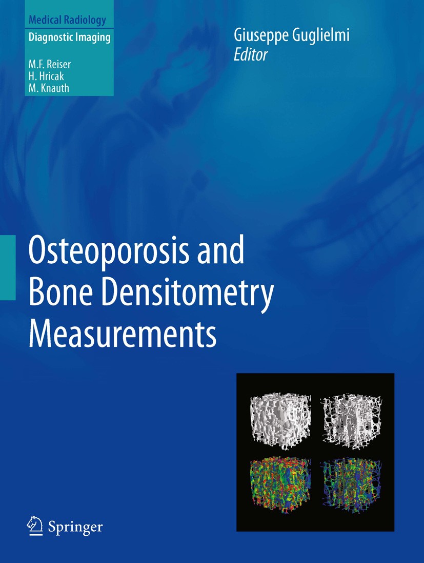 Titlebook: Osteoporosis and Bone Densitometry Measurements; Giuseppe Guglielmi Book 2013 Springer-Verlag Berlin Heidelberg 2013 Bone Densitometry Mea Titlebook: Osteoporosis and Bone Densitometry Measurements; Giuseppe Guglielmi Book 2013 Springer-Verlag Berlin Heidelberg 2013 Bone Densitometry Mea