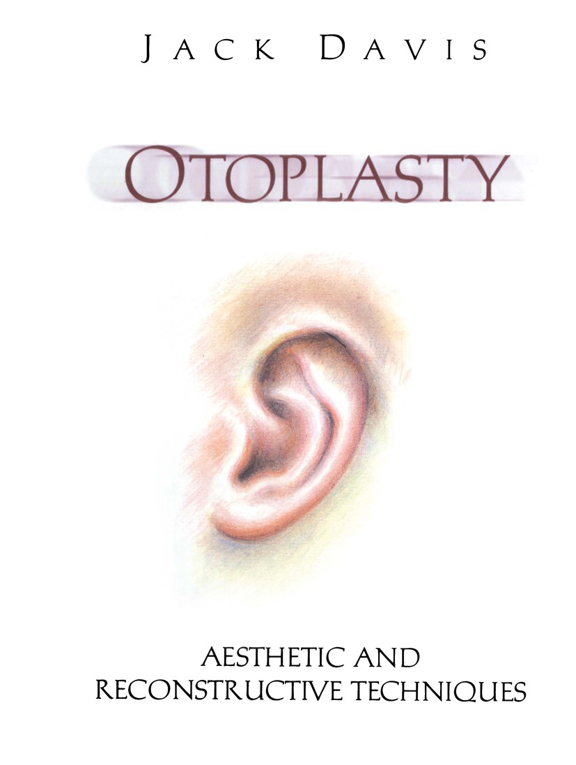 Titlebook: Otoplasty; Aesthetic and Recons Jack Davis Textbook 1997 Springer-Verlag New York Inc. 1997 aesthetic surgery.atresia.ear.microtia.plastic Titlebook: Otoplasty; Aesthetic and Recons Jack Davis Textbook 1997 Springer-Verlag New York Inc. 1997 aesthetic surgery.atresia.ear.microtia.plastic