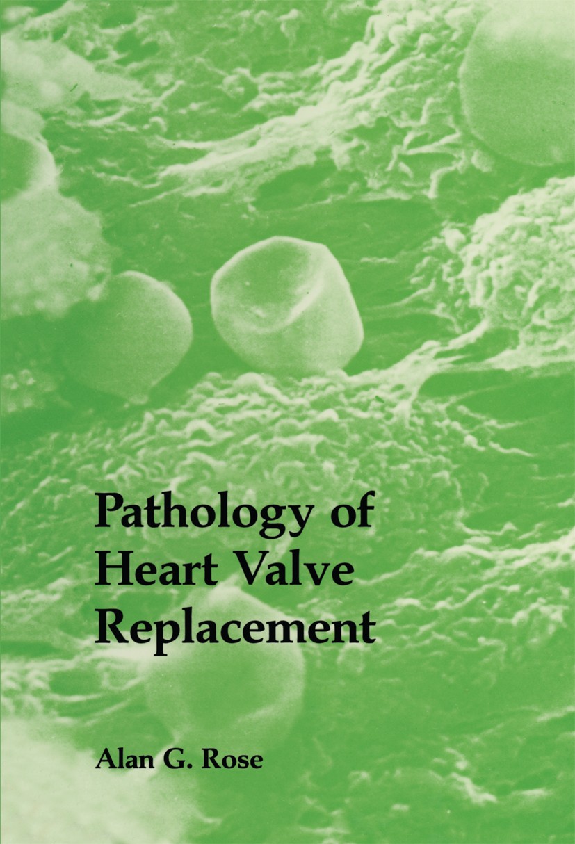Titlebook: Pathology of Heart Valve Replacement; Alan G. Rose Book 1987 MTP Press Limited 1987 heart Titlebook: Pathology of Heart Valve Replacement; Alan G. Rose Book 1987 MTP Press Limited 1987 heart