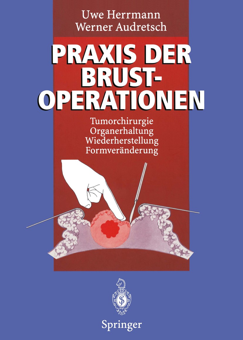 Titlebook: Praxis der Brustoperationen; Tumorchirurgie — Org Uwe Herrmann,Werner Audretsch Book 1996 Springer-Verlag Berlin Heidelberg 1996 Brustopera Titlebook: Praxis der Brustoperationen; Tumorchirurgie — Org Uwe Herrmann,Werner Audretsch Book 1996 Springer-Verlag Berlin Heidelberg 1996 Brustopera