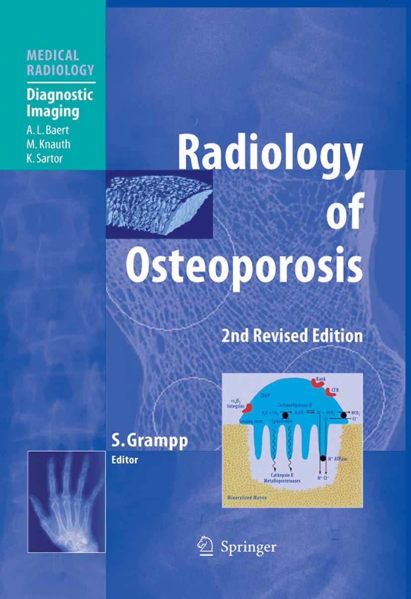 Titlebook: Radiology of Osteoporosis; Stephan Grampp Book 2008Latest edition Springer-Verlag Berlin Heidelberg 2008 X-ray.computed tomography.compute Titlebook: Radiology of Osteoporosis; Stephan Grampp Book 2008Latest edition Springer-Verlag Berlin Heidelberg 2008 X-ray.computed tomography.compute