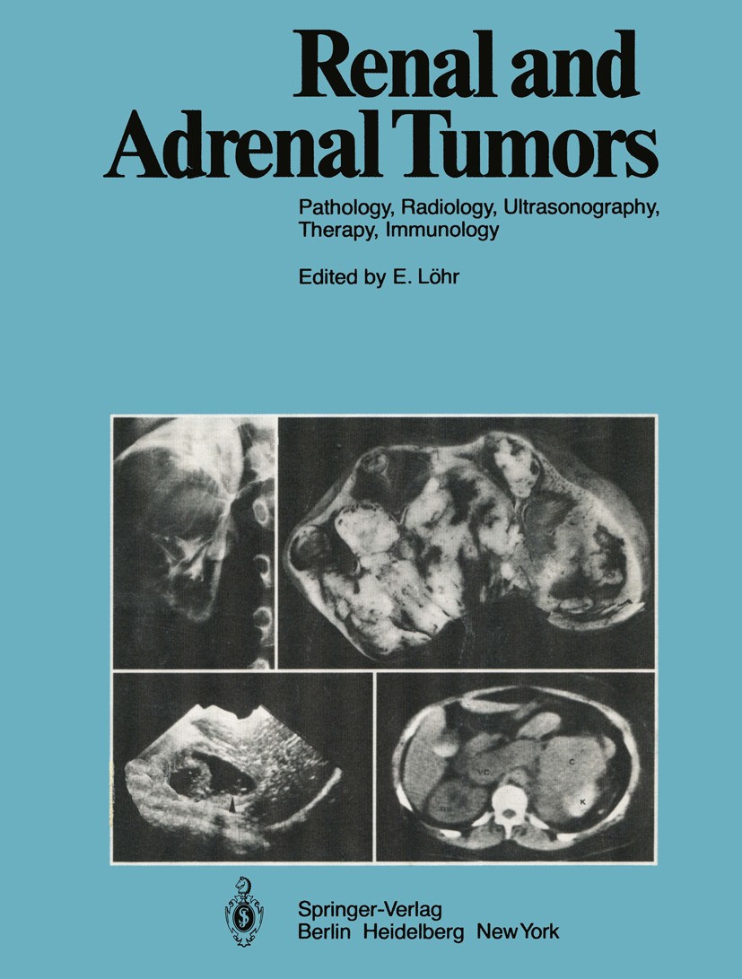 Titlebook: Renal and Adrenal Tumors; Pathology, Radiology R. Ackermann,K. D. Bachmann,G. Wilms,Eberhard Löhr Book 19791st edition Springer-Verlag, Ber Titlebook: Renal and Adrenal Tumors; Pathology, Radiology R. Ackermann,K. D. Bachmann,G. Wilms,Eberhard Löhr Book 19791st edition Springer-Verlag, Ber