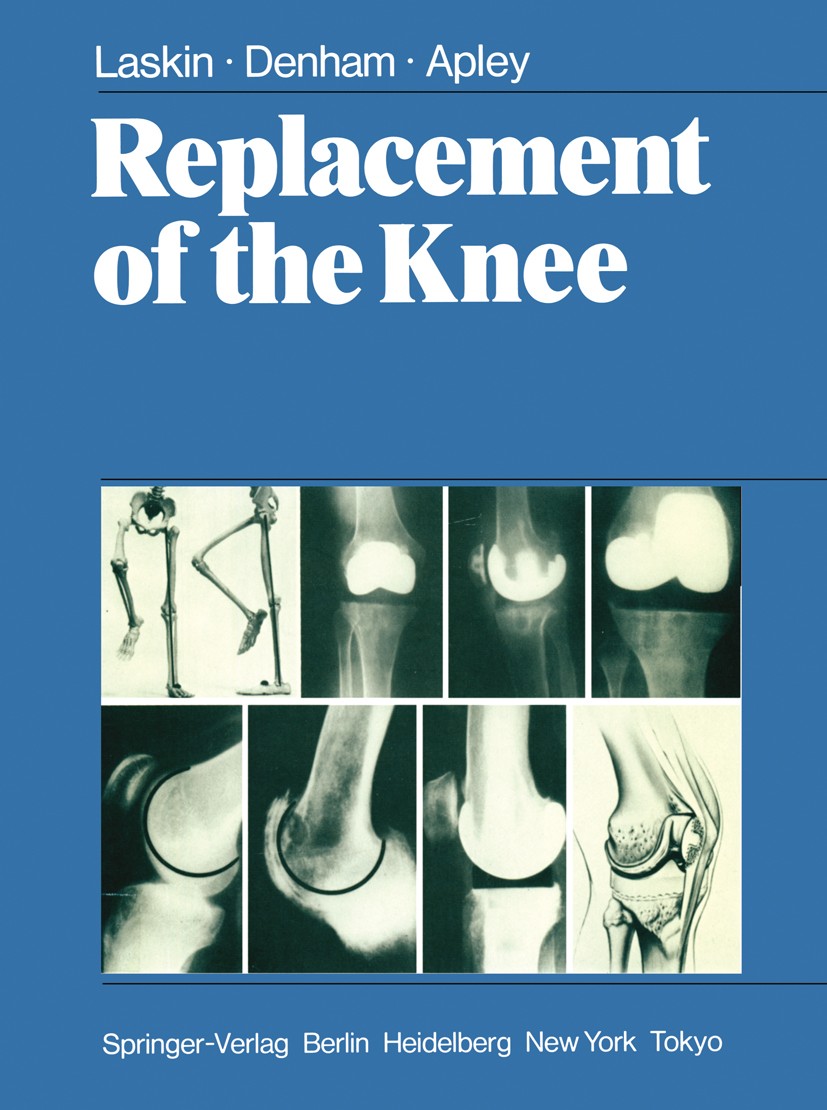 Titlebook: Replacement of the Knee; Richard S. Laskin,Robin A. Denham,A. Graham Apley Book 1984 Springer-Verlag Berlin Heidelberg 1984 Kniegelenkprot Titlebook: Replacement of the Knee; Richard S. Laskin,Robin A. Denham,A. Graham Apley Book 1984 Springer-Verlag Berlin Heidelberg 1984 Kniegelenkprot