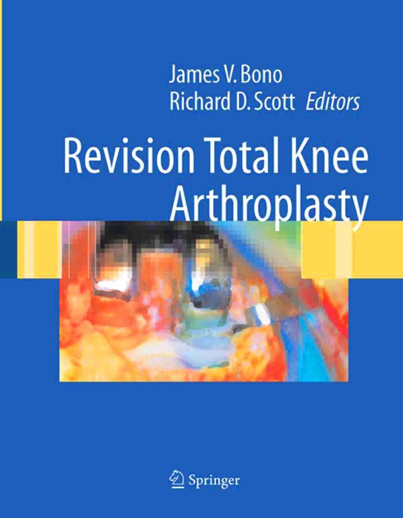 Titlebook: Revision Total Knee Arthroplasty; James V. Bono (Associate Clinical Professor),Richa Book 20051st edition Springer-Verlag New York 2005 Os Titlebook: Revision Total Knee Arthroplasty; James V. Bono (Associate Clinical Professor),Richa Book 20051st edition Springer-Verlag New York 2005 Os