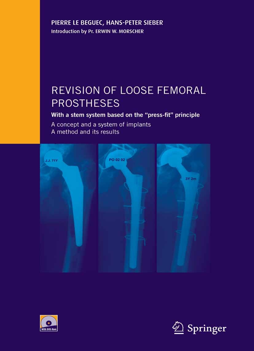 Titlebook: Revision of loose femoral prostheses with a stem system based on the Titlebook: Revision of loose femoral prostheses with a stem system based on the
