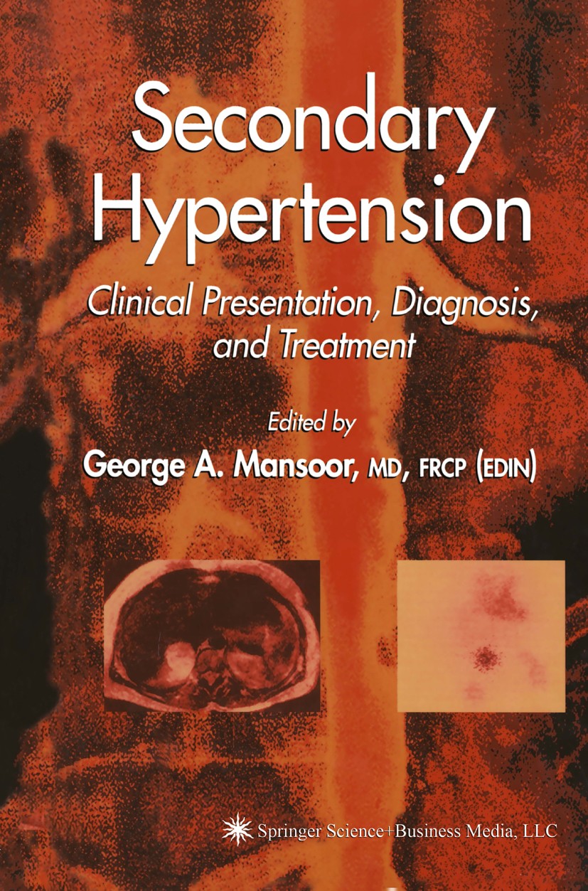 Titlebook: Secondary Hypertension; Clinical Presentatio George A. Mansoor Book 2004 Springer Science+Business Media New York 2004 drugs.endocrinology. Titlebook: Secondary Hypertension; Clinical Presentatio George A. Mansoor Book 2004 Springer Science+Business Media New York 2004 drugs.endocrinology.