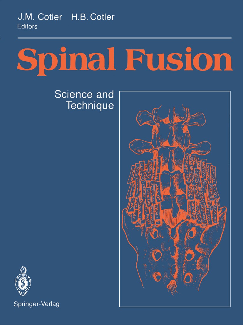 Titlebook: Spinal Fusion; Science and Techniqu Jerome M. Cotler (Professor and Vice Chairman),How Book 1990 Springer-Verlag New York Inc. 1990 Chirugi Titlebook: Spinal Fusion; Science and Techniqu Jerome M. Cotler (Professor and Vice Chairman),How Book 1990 Springer-Verlag New York Inc. 1990 Chirugi