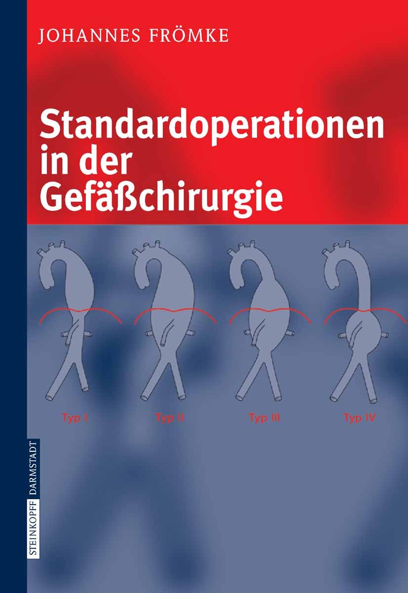 Titlebook: Standardoperationen in der Gefäßchirurgie; Johannes Frömke Book 2006 Steinkopff-Verlag Darmstadt 2006 Gefäßchirurgie.Gefäßdiagnostik.Gefäß Titlebook: Standardoperationen in der Gefäßchirurgie; Johannes Frömke Book 2006 Steinkopff-Verlag Darmstadt 2006 Gefäßchirurgie.Gefäßdiagnostik.Gefäß