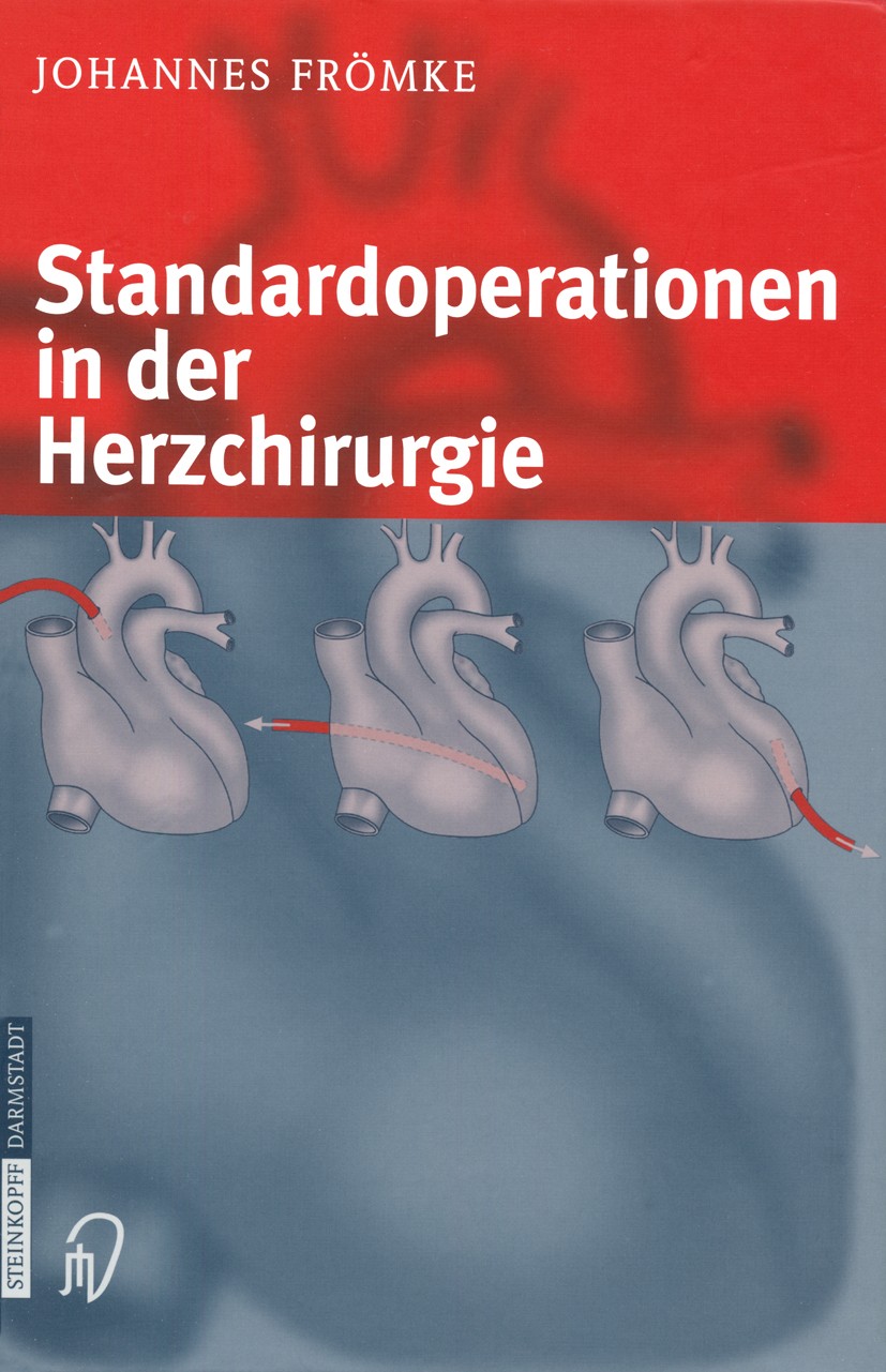 Titlebook: Standardoperationen in der Herzchirurgie; Johannes Frömke Book 2003 Springer-Verlag Berlin Heidelberg 2003 Herz-Lungen-Maschine.Herzchirur Titlebook: Standardoperationen in der Herzchirurgie; Johannes Frömke Book 2003 Springer-Verlag Berlin Heidelberg 2003 Herz-Lungen-Maschine.Herzchirur