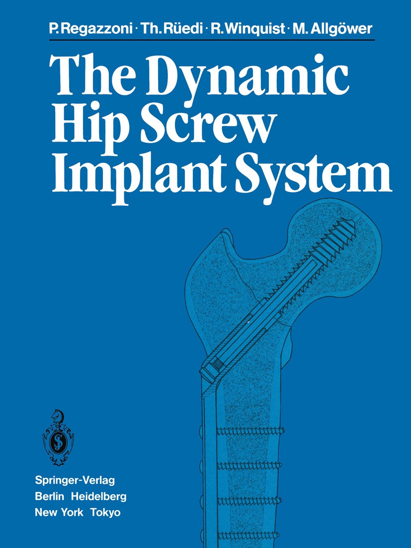 Titlebook: The Dynamic Hip Screw Implant System; Pietro Regazzoni,Thomas Rüedi,Martin Allgöwer Book 1985 Springer-Verlag Berlin Heidelberg 1985 Syste Titlebook: The Dynamic Hip Screw Implant System; Pietro Regazzoni,Thomas Rüedi,Martin Allgöwer Book 1985 Springer-Verlag Berlin Heidelberg 1985 Syste