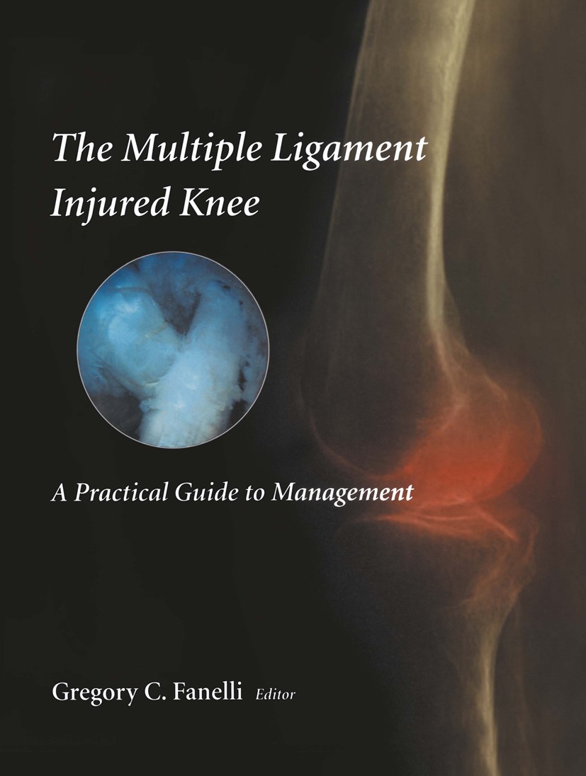 Titlebook: The Multiple Ligament Injured Knee; A Practical Guide to Gregory C. Fanelli (Chief) Book 20041st edition Springer Science+Business Media Ne Titlebook: The Multiple Ligament Injured Knee; A Practical Guide to Gregory C. Fanelli (Chief) Book 20041st edition Springer Science+Business Media Ne