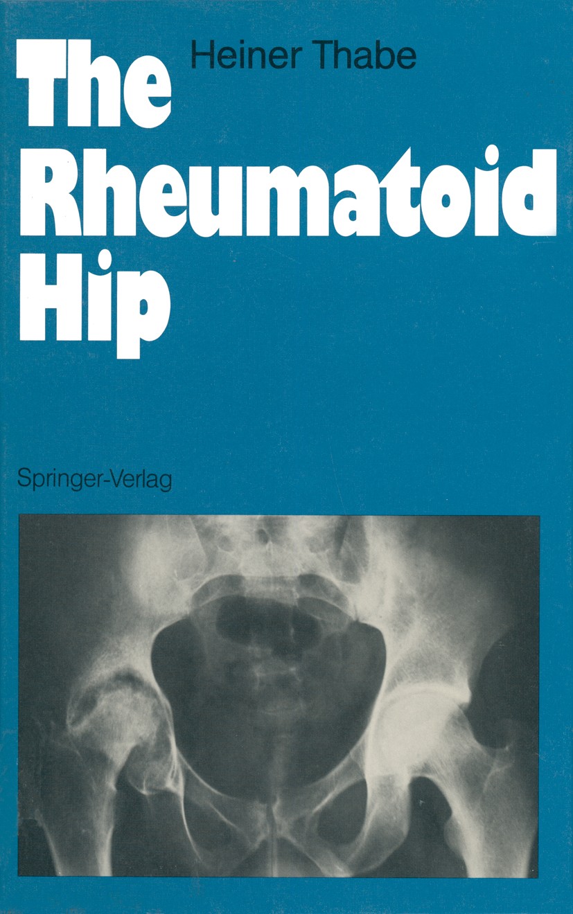 Titlebook: The Rheumatoid Hip; Heiner Thabe Book 1990 Springer-Verlag Berlin Heidelberg 1990 Arthritis.Behandlungskonzept.Conservative and invasive t Titlebook: The Rheumatoid Hip; Heiner Thabe Book 1990 Springer-Verlag Berlin Heidelberg 1990 Arthritis.Behandlungskonzept.Conservative and invasive t