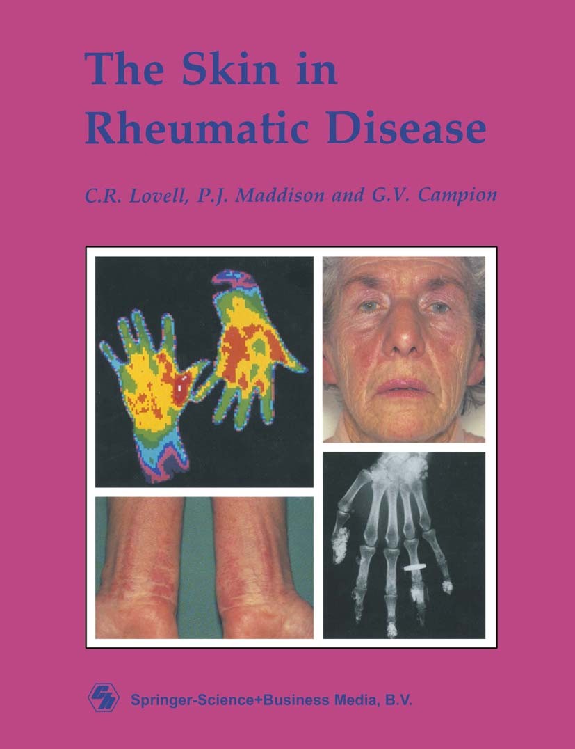 Titlebook: The Skin in Rheumatic Disease; C. R. Lovell,P. J. Maddison,G. V. Campion Book 1990 C.R. Lovell, P.J. Maddison and G.V. Campion 1990 Arthri Titlebook: The Skin in Rheumatic Disease; C. R. Lovell,P. J. Maddison,G. V. Campion Book 1990 C.R. Lovell, P.J. Maddison and G.V. Campion 1990 Arthri