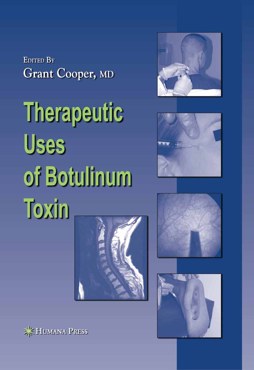 Titlebook: Therapeutic Uses of Botulinum Toxin; Grant Cooper Book 2007 Humana Press 2007 Hyperhidrosis.drug.neurotransmitter.research.rehabilitation Titlebook: Therapeutic Uses of Botulinum Toxin; Grant Cooper Book 2007 Humana Press 2007 Hyperhidrosis.drug.neurotransmitter.research.rehabilitation