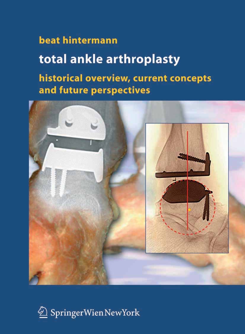 Titlebook: Total Ankle Arthroplasty; Historical Overview, Beat Hintermann Book 2005 Springer-Verlag Vienna 2005 ankle.ankle arthrodesis.ankle joint.ar Titlebook: Total Ankle Arthroplasty; Historical Overview, Beat Hintermann Book 2005 Springer-Verlag Vienna 2005 ankle.ankle arthrodesis.ankle joint.ar