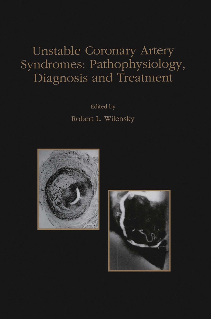 Titlebook: Unstable Coronary Artery Syndromes Pathophysiology, Diagnosis and Treatment; Robert L. Wilensky Book 1998 Springer Science+Business Media Titlebook: Unstable Coronary Artery Syndromes Pathophysiology, Diagnosis and Treatment; Robert L. Wilensky Book 1998 Springer Science+Business Media